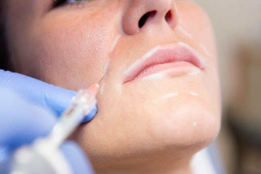 Medical procedure with hyaluronic acid
